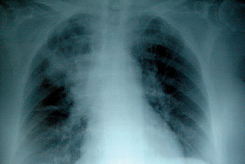 Neumonía apical derecha en la FQ, la infección crónica da lugar a la destrucción del parénquima pulmonar, ocasionando por último la muerte por insuficiencia respiratoria.