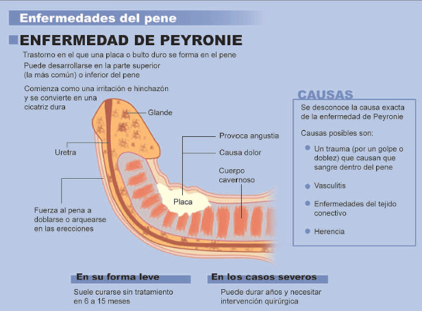 La mayoría de los hombres con curvatura de pene o enfermedad de Peyronie no...