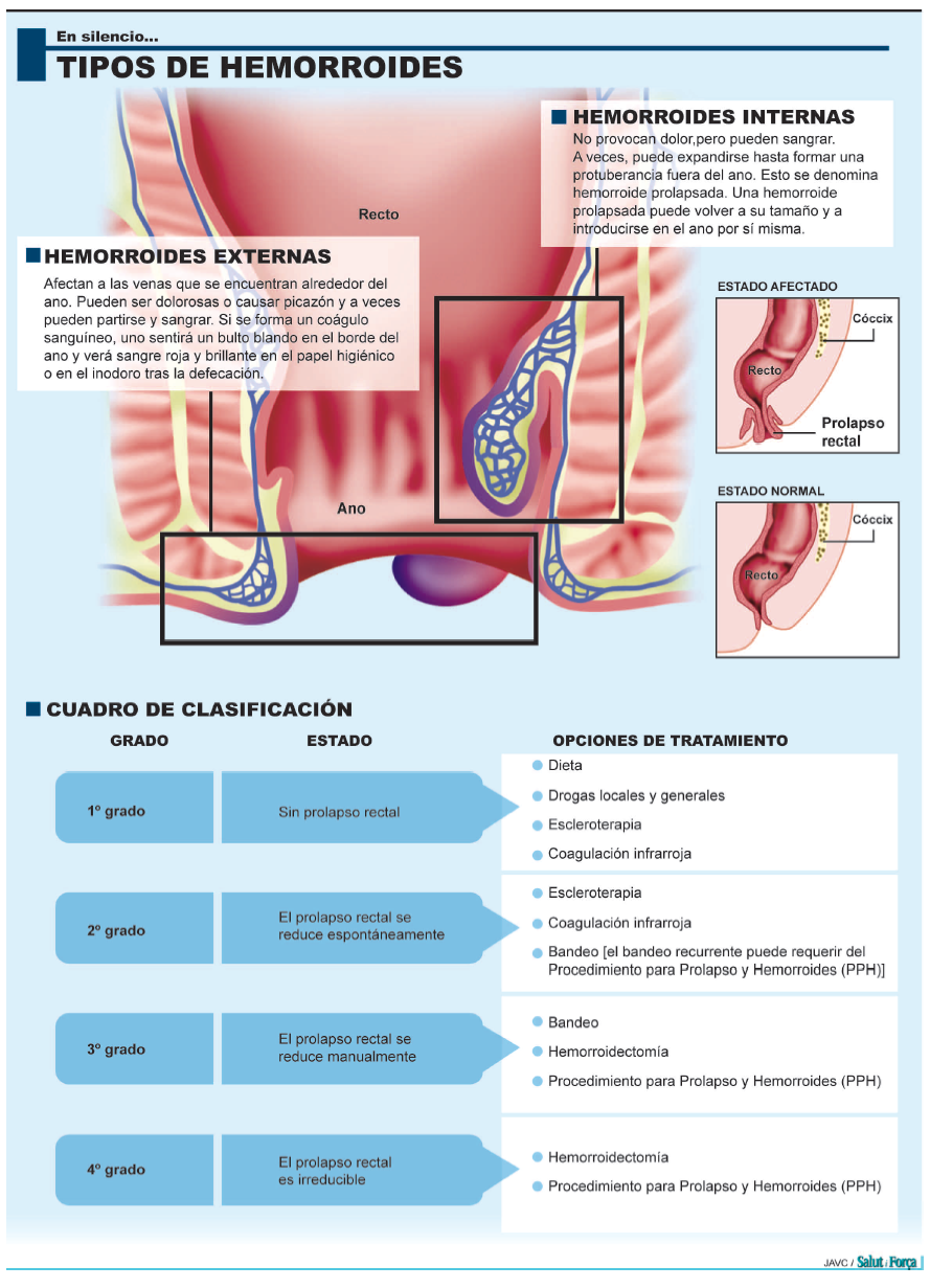 hemorroides-3