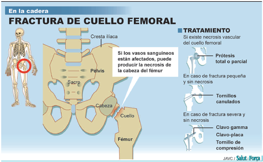 fractura-cuello-femoral