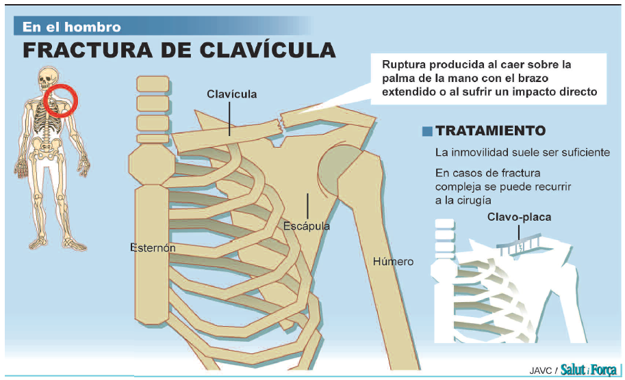 fractura-de-clavicula