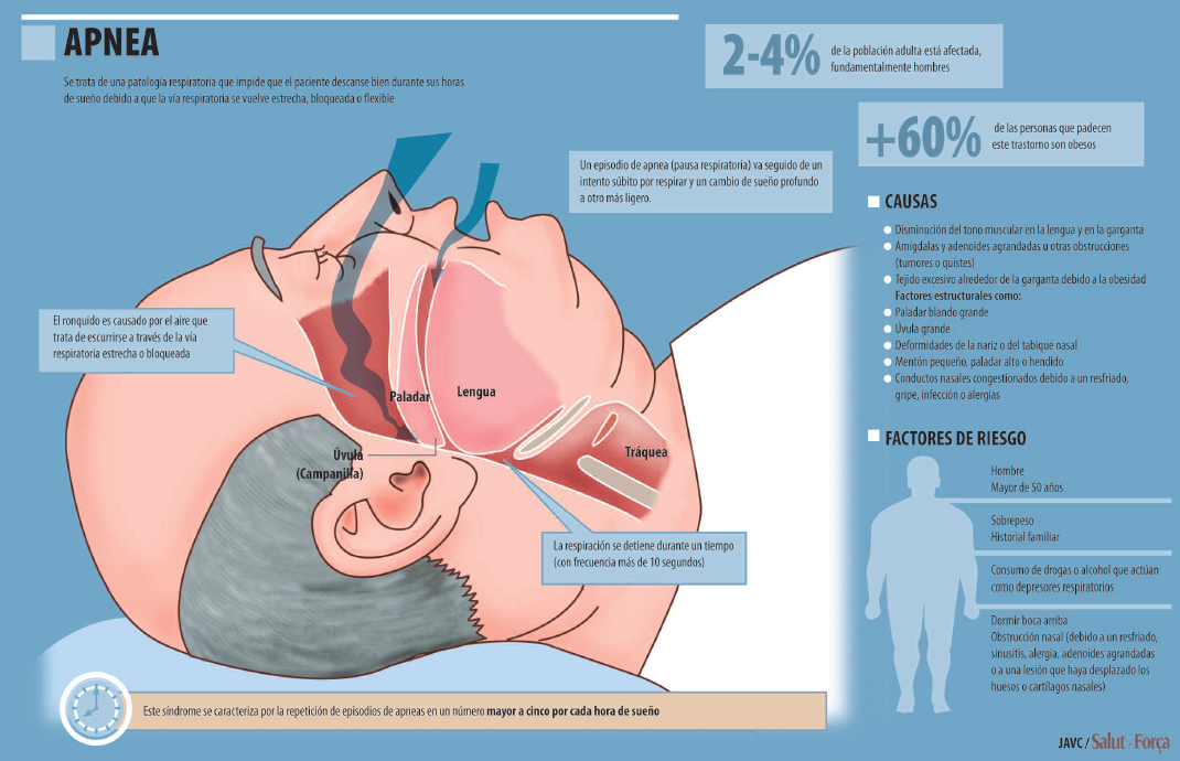 Apnea del sueño – Salud Ediciones