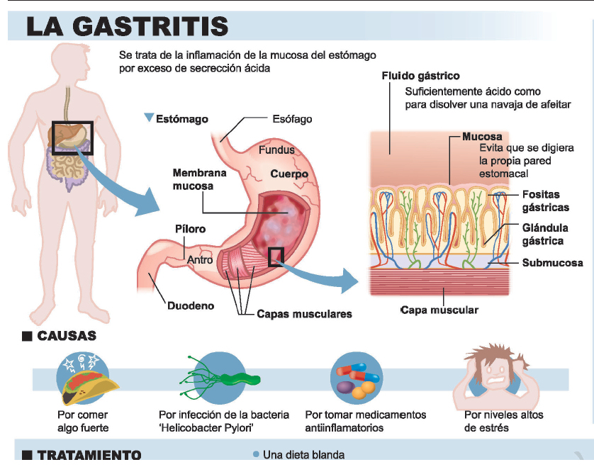 Que puedo tomar para la inflamacion de estomago