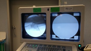 Visión por rayos x de la rodilla intervenida