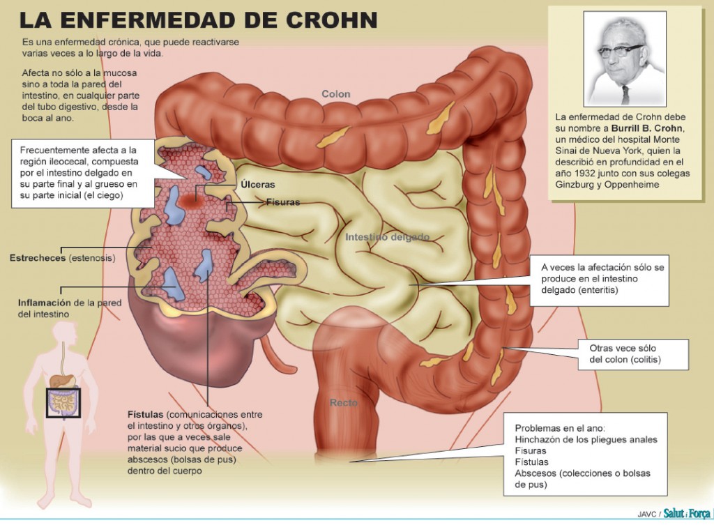 Inflamación intestino sintomas