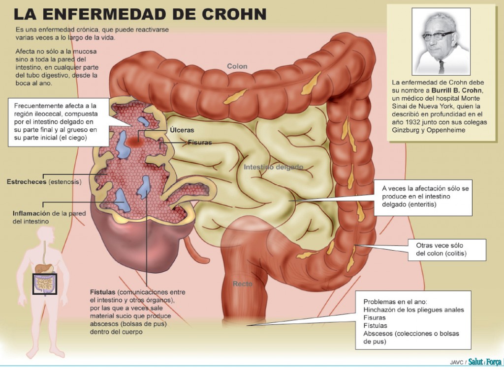 Enfermedad de hashimoto tratamiento