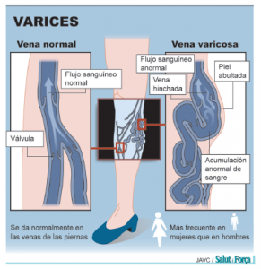 varices-1