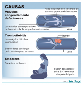 varices-3