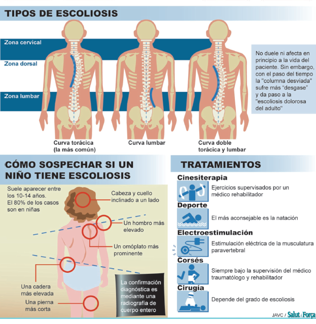 tipos-escoliosis