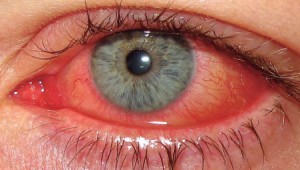 conjuntivitis-alergica