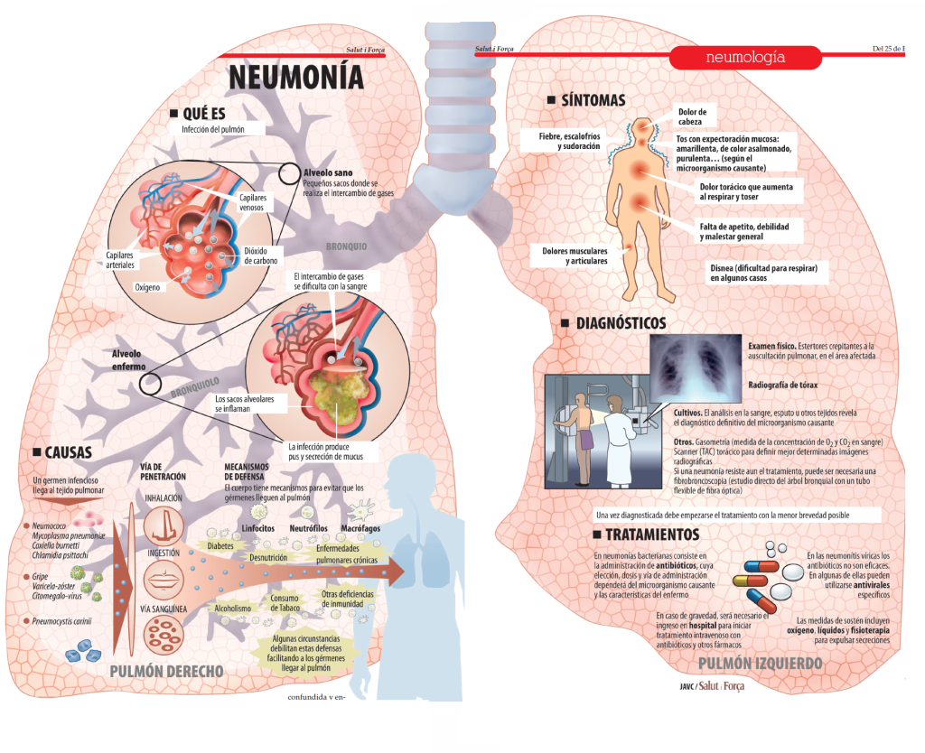 neumonia