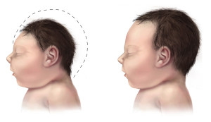 Un bebé con microcefalia (izq) en comparación con un bebé sin microcefalia (der)