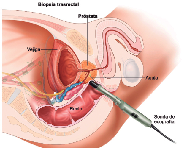 prostatectomía radical pdf