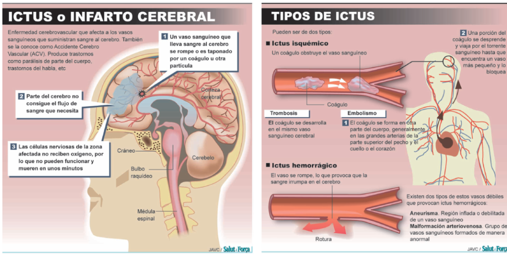 ictus