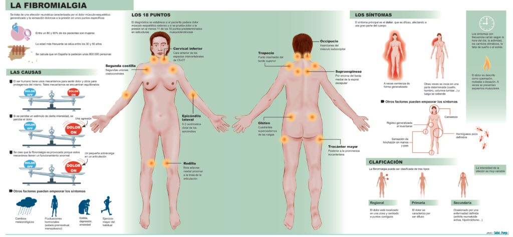 Fibromialgia puntos dolorosos