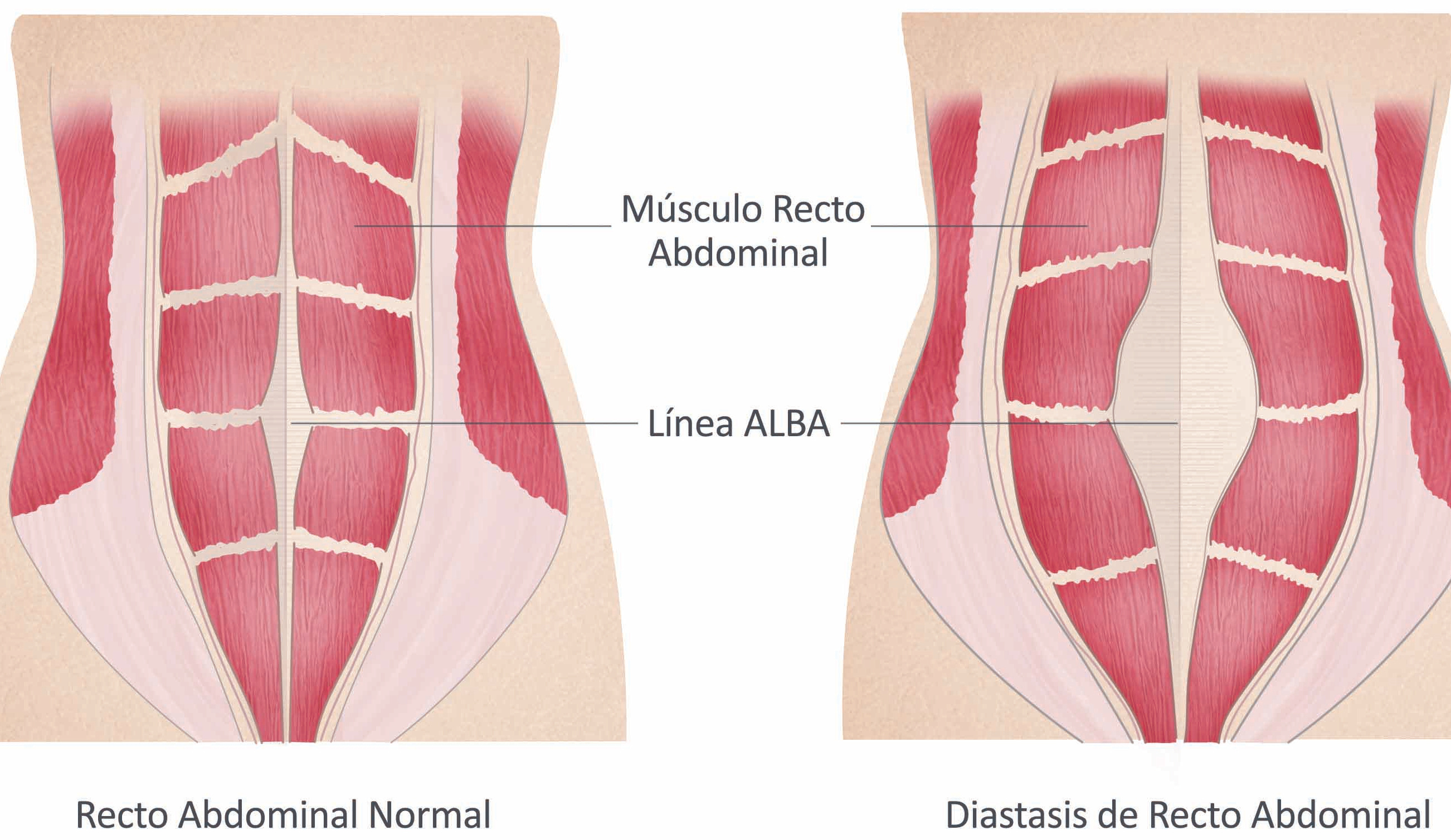 Cirugía mínimamente invasiva de la pared abdominal: Hernias, Eventraciones  y Diástasis de rectos - Cirugía Laparoscópica Madrid