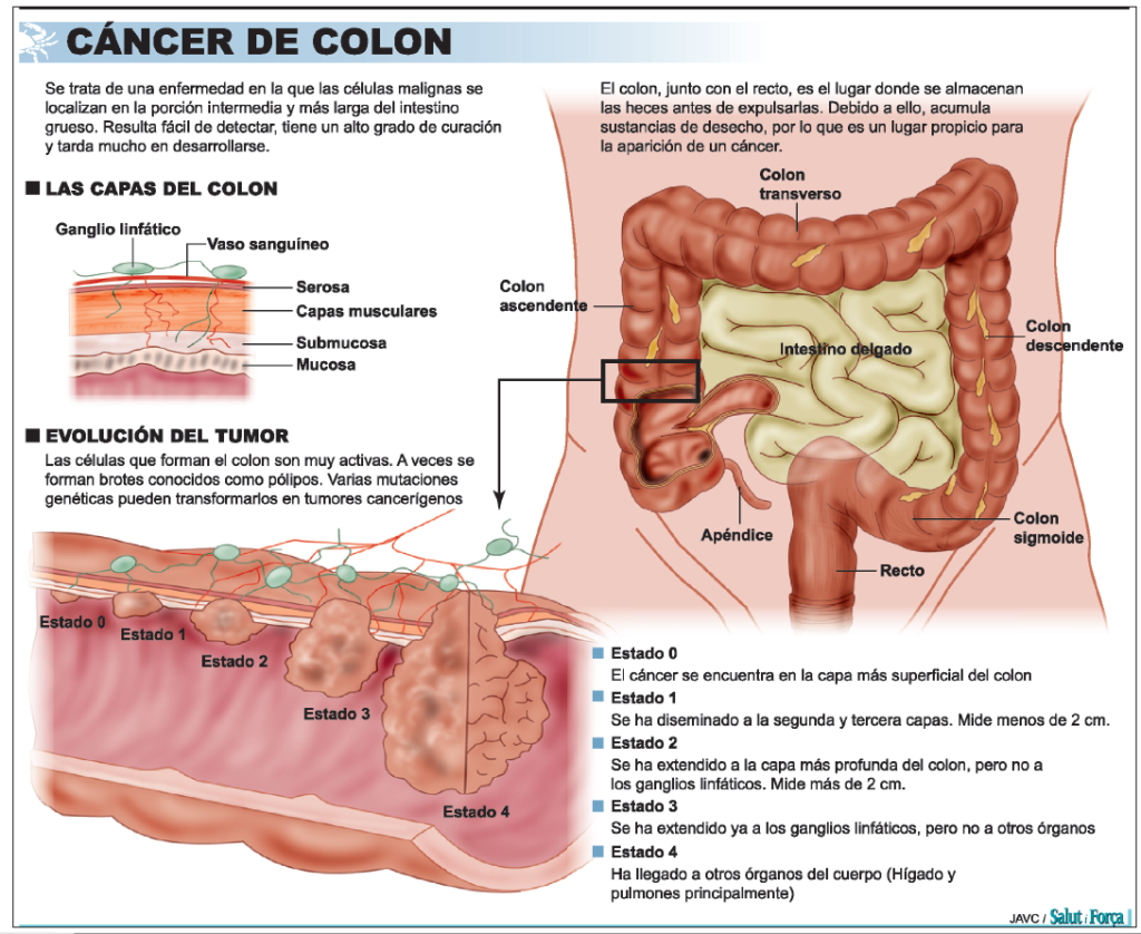 Cáncer de colon consultar al médico sin perder la calma Salud Ediciones Cáncer de colon consultar al médico sin perder la calma Salud Ediciones