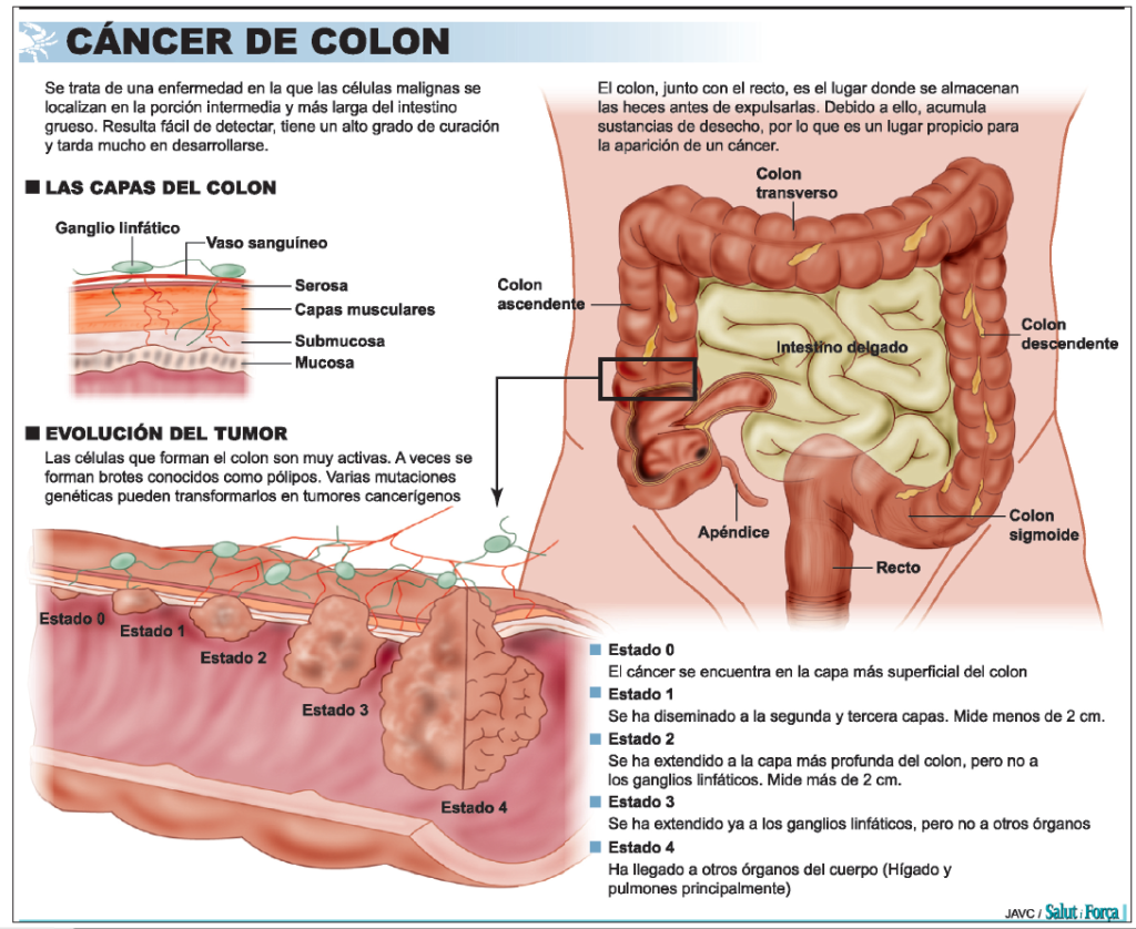 cancer colon que es