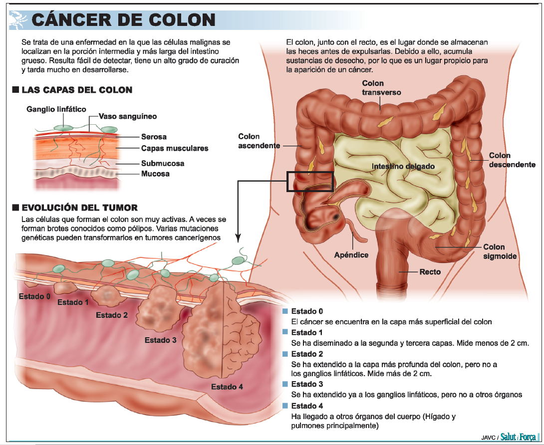 Se puede vivir con cancer de colon