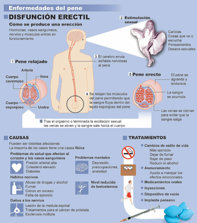 próstata y disfunción eréctil